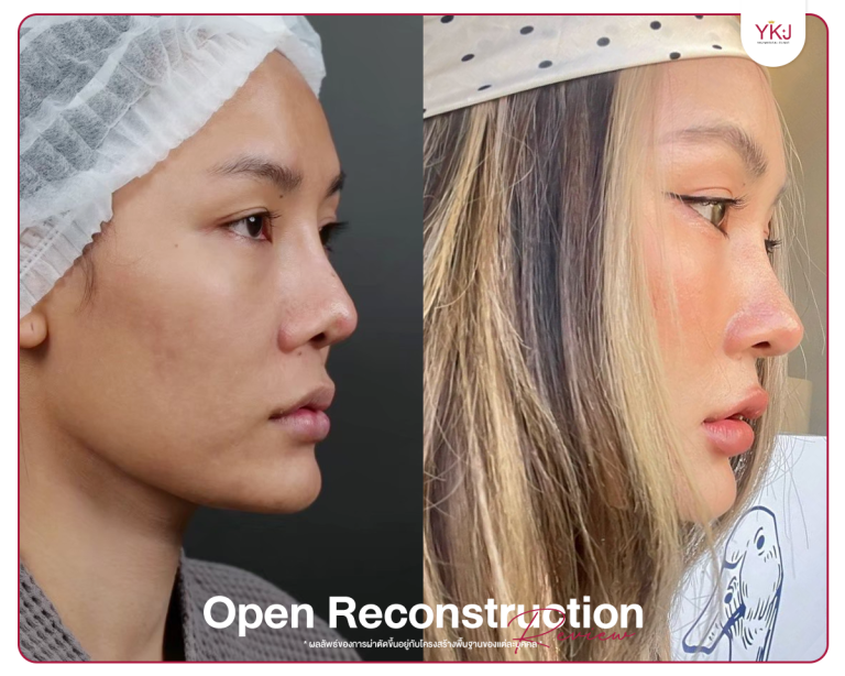 รีวิวแก้จมูก , รีวิวเสริมจมูกโอเพ่น , กระดูกซี่โครง , กระดูกอ่อนหลังหู