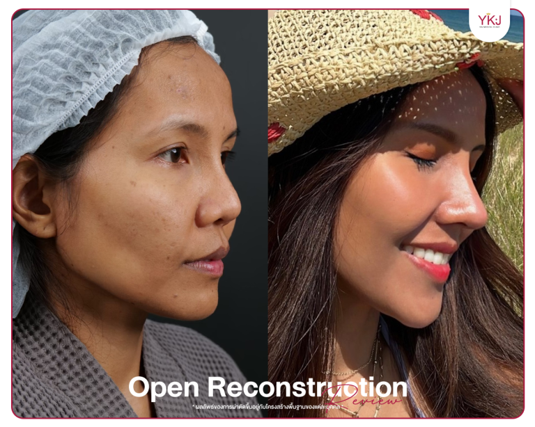 รีวิวแก้จมูก , รีวิวเสริมจมูกโอเพ่น , กระดูกซี่โครง , กระดูกอ่อนหลังหู