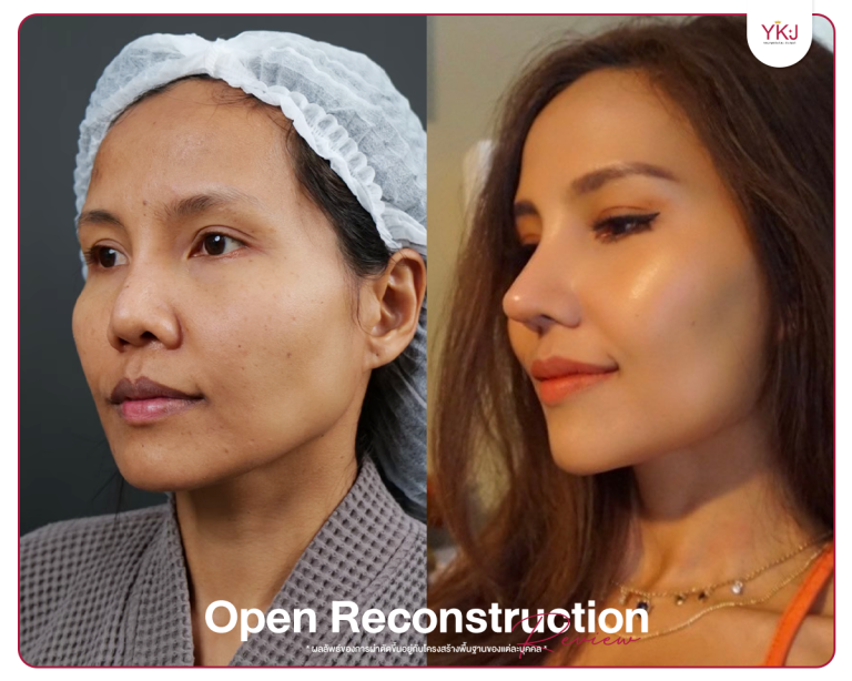 รีวิวแก้จมูก , รีวิวเสริมจมูกโอเพ่น , กระดูกซี่โครง , กระดูกอ่อนหลังหู