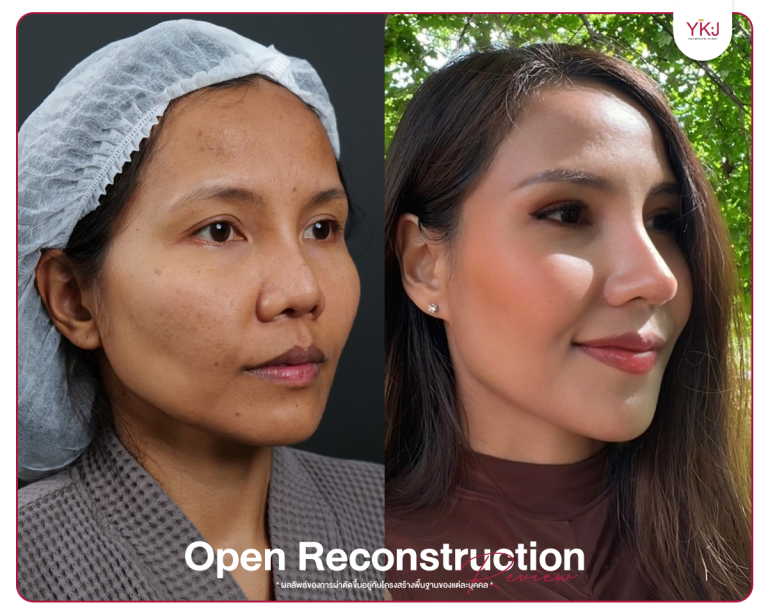 รีวิวแก้จมูก , รีวิวเสริมจมูกโอเพ่น , กระดูกซี่โครง , กระดูกอ่อนหลังหู