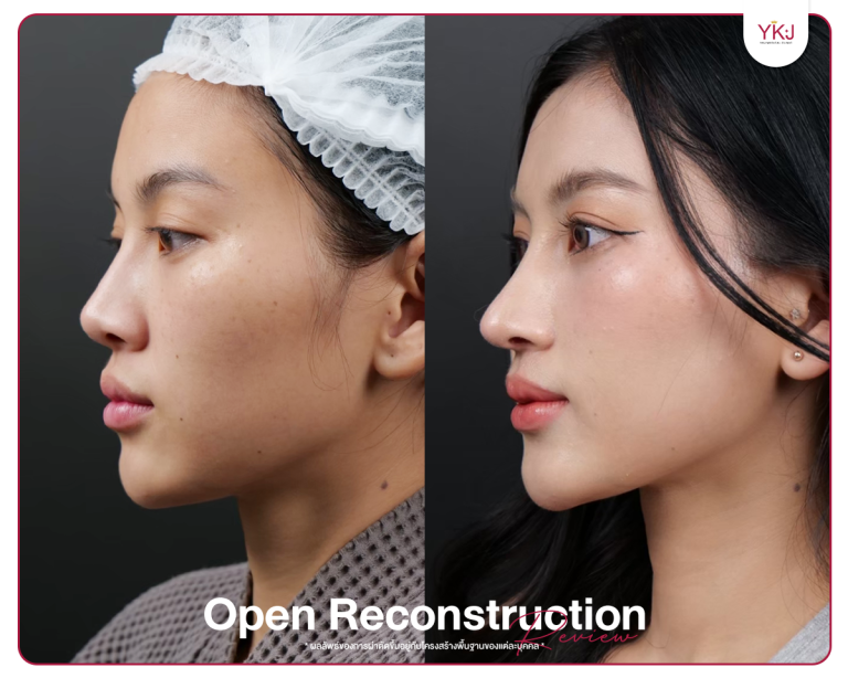 รีวิวแก้จมูก , รีวิวเสริมจมูกโอเพ่น , กระดูกซี่โครง , กระดูกอ่อนหลังหู