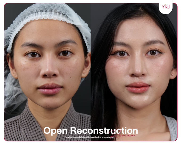 รีวิวแก้จมูก , รีวิวเสริมจมูกโอเพ่น , กระดูกซี่โครง , กระดูกอ่อนหลังหู