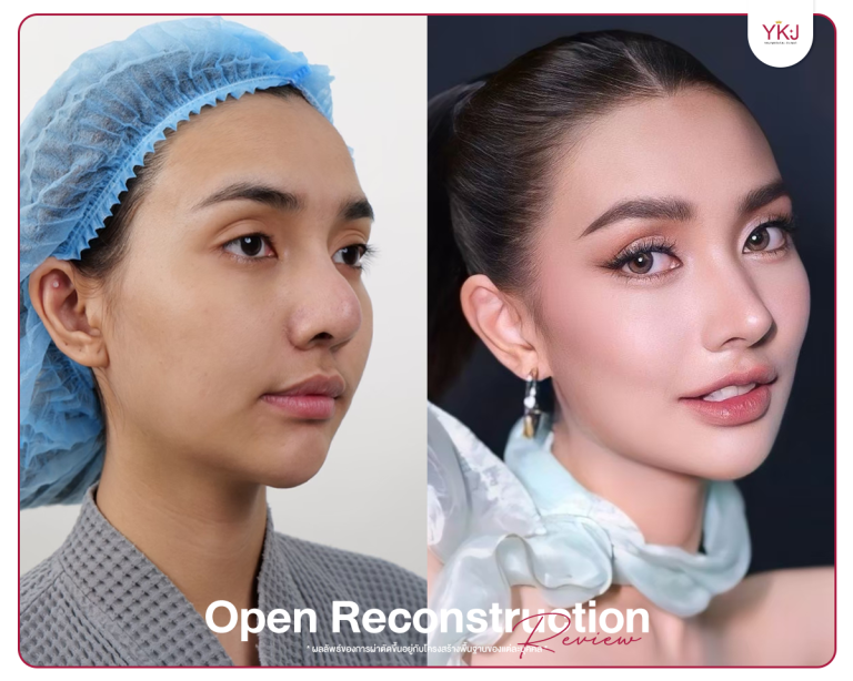 รีวิวแก้จมูก , รีวิวเสริมจมูกโอเพ่น , กระดูกซี่โครง , กระดูกอ่อนหลังหู