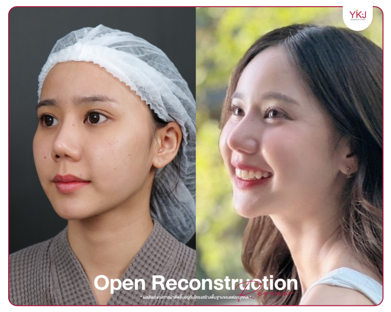 รีวิวแก้จมูก , รีวิวเสริมจมูกโอเพ่น , กระดูกซี่โครง , กระดูกอ่อนหลังหู