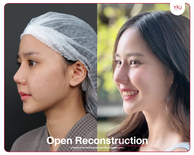 รีวิวแก้จมูก , รีวิวเสริมจมูกโอเพ่น , กระดูกซี่โครง , กระดูกอ่อนหลังหู