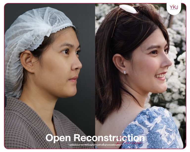 รีวิวแก้จมูก , รีวิวเสริมจมูกโอเพ่น , กระดูกซี่โครง , กระดูกอ่อนหลังหู