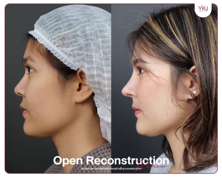 รีวิวแก้จมูก , รีวิวเสริมจมูกโอเพ่น , กระดูกซี่โครง , กระดูกอ่อนหลังหู