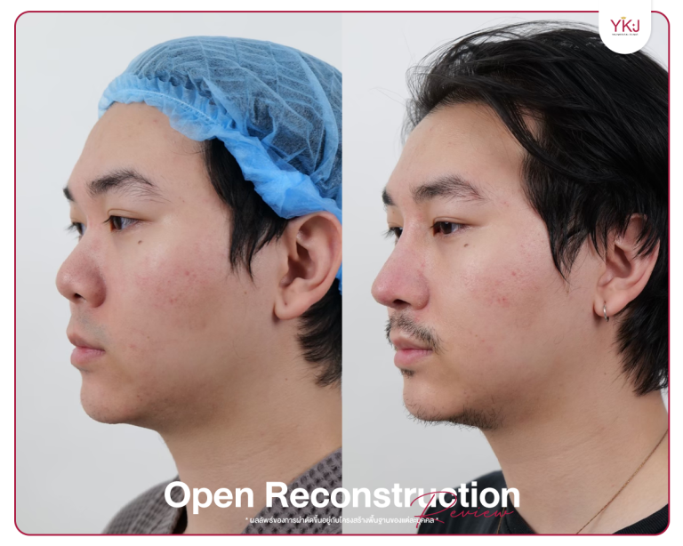 รีวิวแก้จมูก , รีวิวเสริมจมูกโอเพ่น , กระดูกซี่โครง , กระดูกอ่อนหลังหู