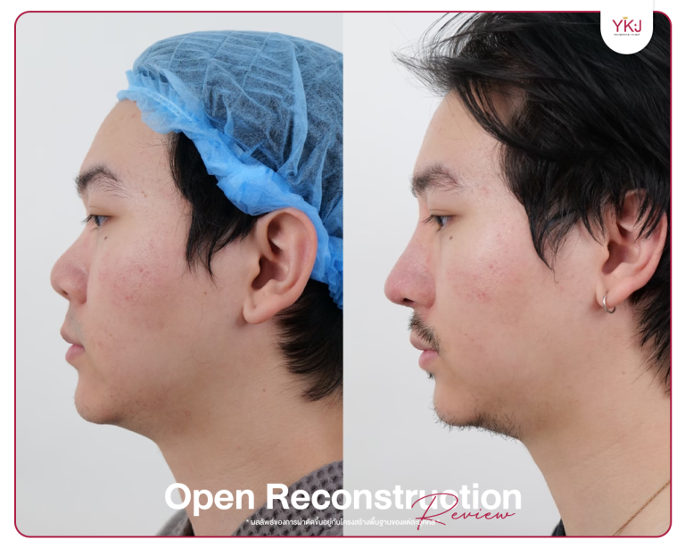รีวิวแก้จมูก , รีวิวเสริมจมูกโอเพ่น , กระดูกซี่โครง , กระดูกอ่อนหลังหู