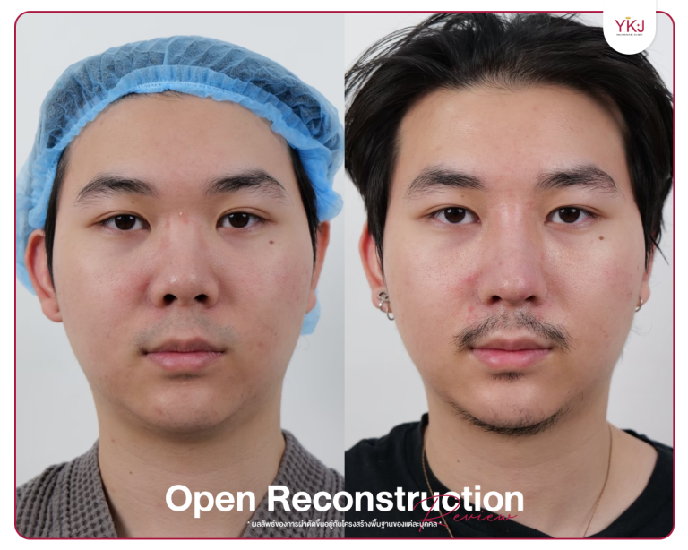 รีวิวแก้จมูก , รีวิวเสริมจมูกโอเพ่น , กระดูกซี่โครง , กระดูกอ่อนหลังหู