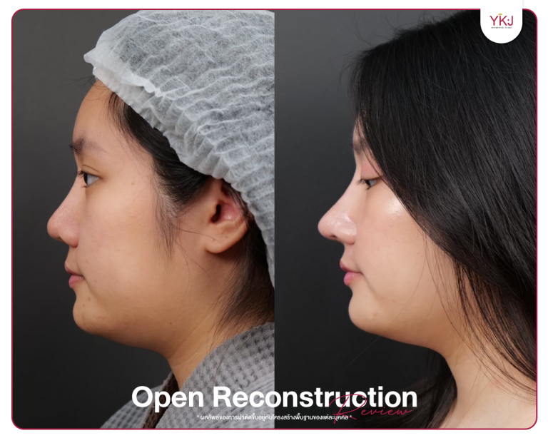 รีวิวแก้จมูก , รีวิวเสริมจมูกโอเพ่น , กระดูกซี่โครง , กระดูกอ่อนหลังหู