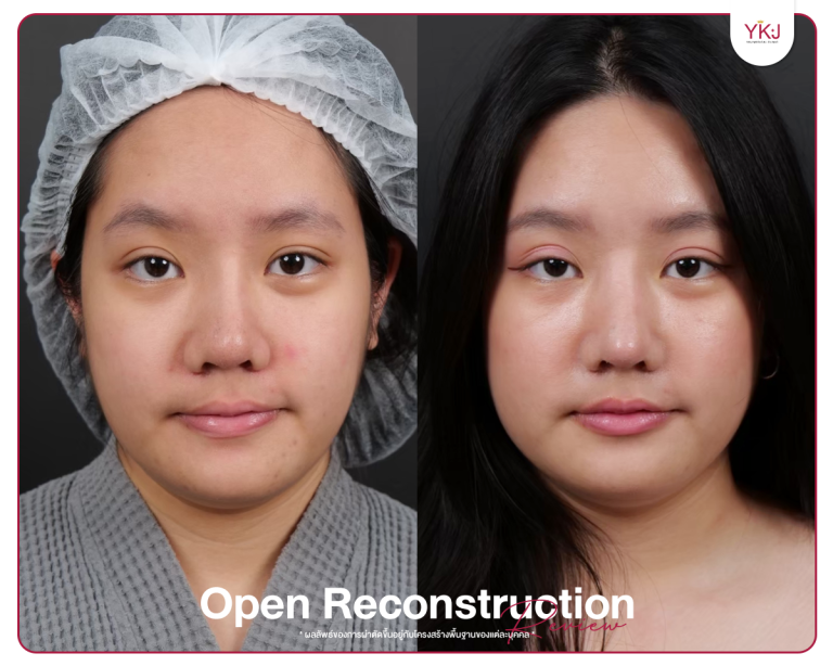 รีวิวแก้จมูก , รีวิวเสริมจมูกโอเพ่น , กระดูกซี่โครง , กระดูกอ่อนหลังหู