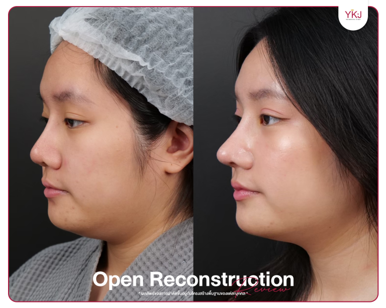 รีวิวแก้จมูก , รีวิวเสริมจมูกโอเพ่น , กระดูกซี่โครง , กระดูกอ่อนหลังหู