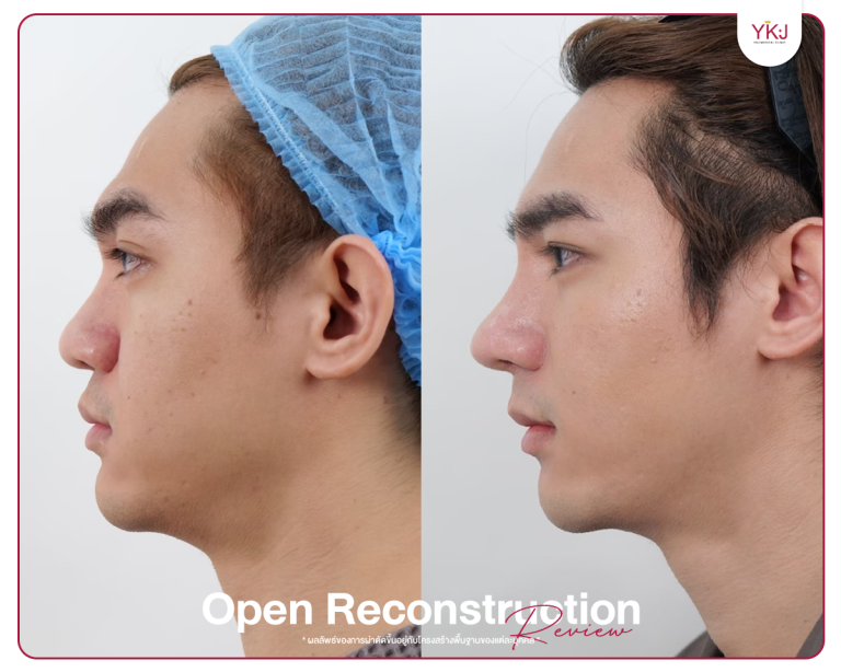 รีวิวแก้จมูก , รีวิวเสริมจมูกโอเพ่น , กระดูกซี่โครง , กระดูกอ่อนหลังหู