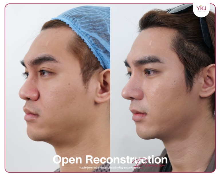 รีวิวแก้จมูก , รีวิวเสริมจมูกโอเพ่น , กระดูกซี่โครง , กระดูกอ่อนหลังหู