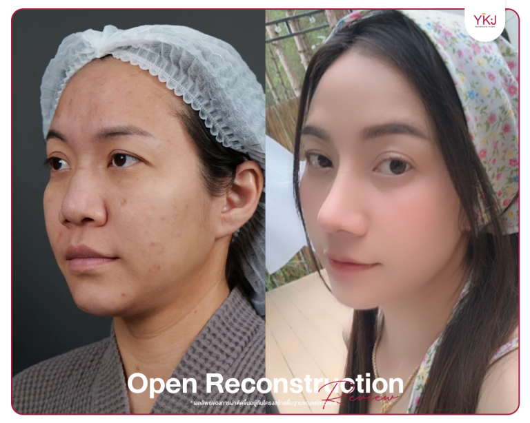 รีวิวแก้จมูก , รีวิวเสริมจมูกโอเพ่น , กระดูกซี่โครง , กระดูกอ่อนหลังหู