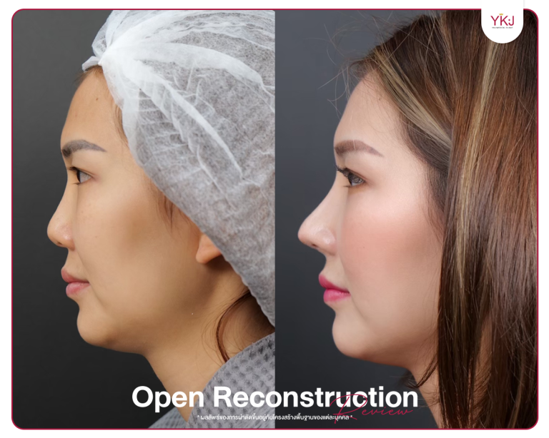 รีวิวแก้จมูก , รีวิวเสริมจมูกโอเพ่น , กระดูกซี่โครง , กระดูกอ่อนหลังหู