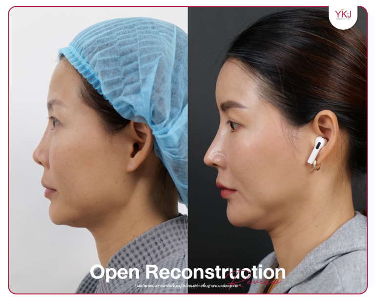 รีวิวแก้จมูก , รีวิวเสริมจมูกโอเพ่น , กระดูกซี่โครง , กระดูกอ่อนหลังหู