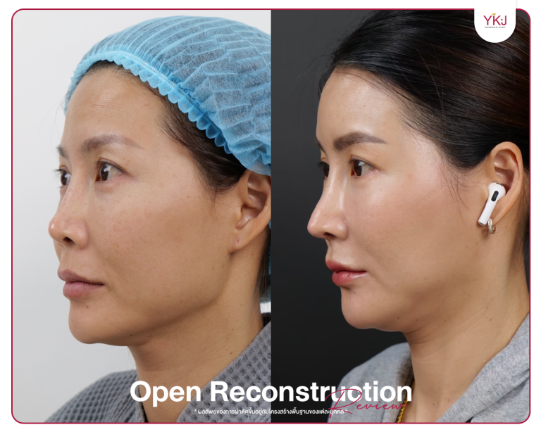 รีวิวแก้จมูก , รีวิวเสริมจมูกโอเพ่น , กระดูกซี่โครง , กระดูกอ่อนหลังหู