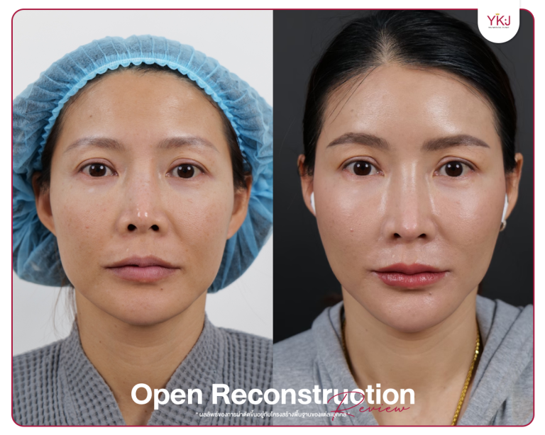 รีวิวแก้จมูก , รีวิวเสริมจมูกโอเพ่น , กระดูกซี่โครง , กระดูกอ่อนหลังหู