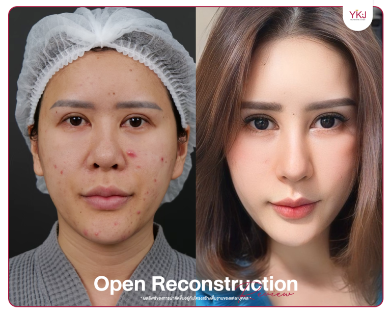 รีวิวแก้จมูก , รีวิวเสริมจมูกโอเพ่น , กระดูกซี่โครง , กระดูกอ่อนหลังหู