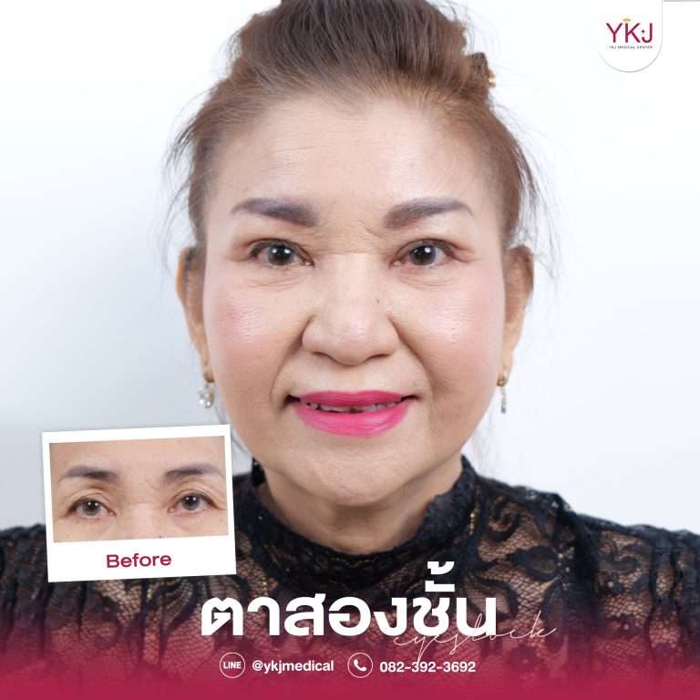 รีวิวตาสองชั้น , รีวิวแก้ตาสองชั้น, ทำตาสองชั้น