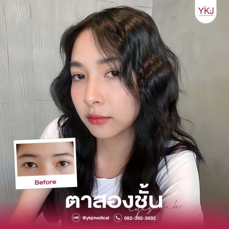 รีวิวตาสองชั้น , รีวิวแก้ตาสองชั้น, ทำตาสองชั้น