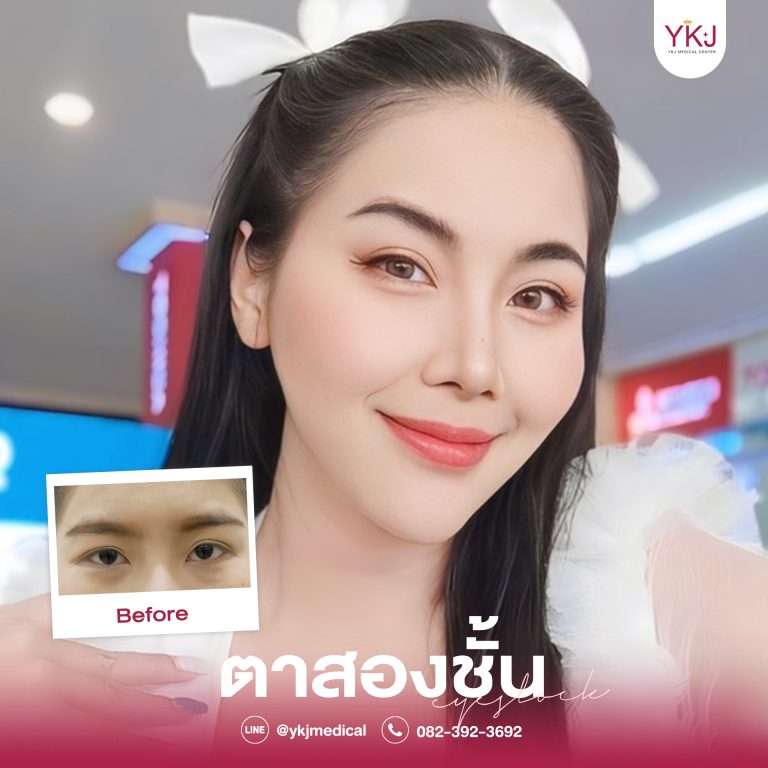 รีวิวตาสองชั้น , รีวิวแก้ตาสองชั้น, ทำตาสองชั้น