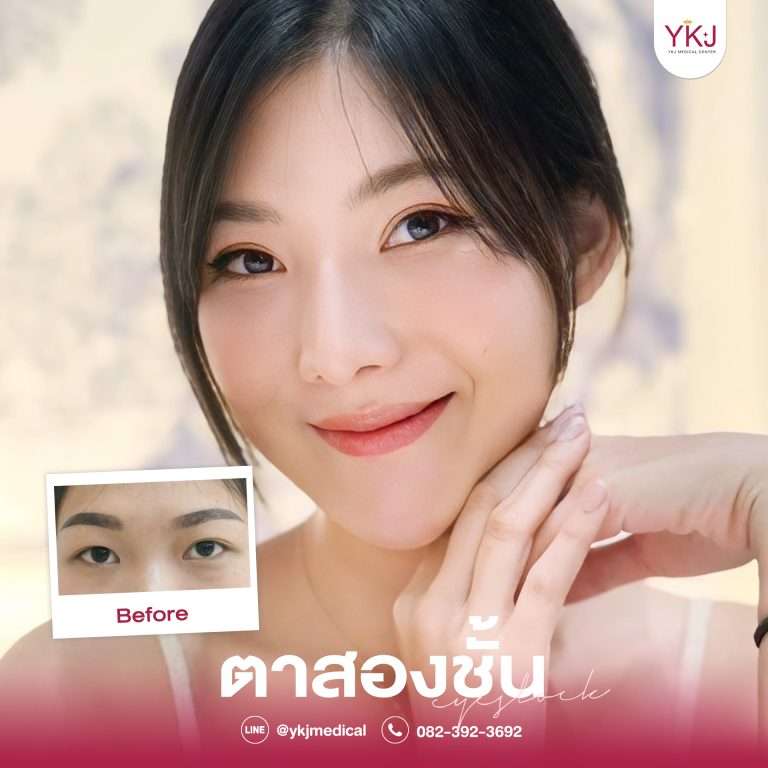 รีวิวตาสองชั้น , รีวิวแก้ตาสองชั้น, ทำตาสองชั้น