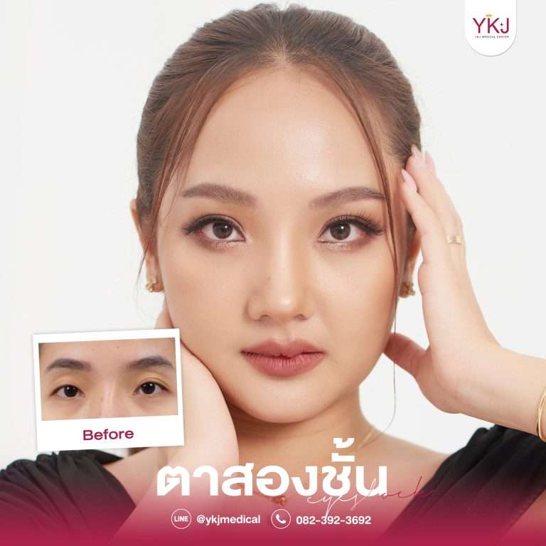 รีวิวตาสองชั้น , รีวิวแก้ตาสองชั้น, ทำตาสองชั้น