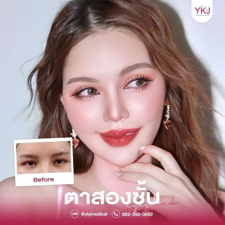 รีวิวตาสองชั้น , รีวิวแก้ตาสองชั้น, ทำตาสองชั้น