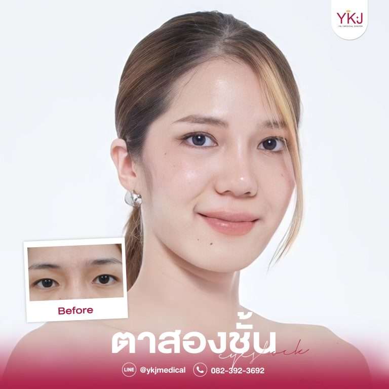 รีวิวตาสองชั้น , รีวิวแก้ตาสองชั้น, ทำตาสองชั้น