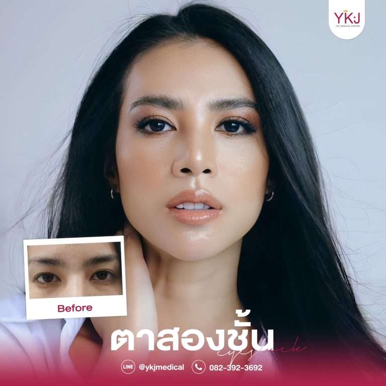 รีวิวตาสองชั้น , รีวิวแก้ตาสองชั้น, ทำตาสองชั้น