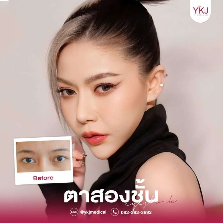 รีวิวตาสองชั้น , รีวิวแก้ตาสองชั้น, ทำตาสองชั้น