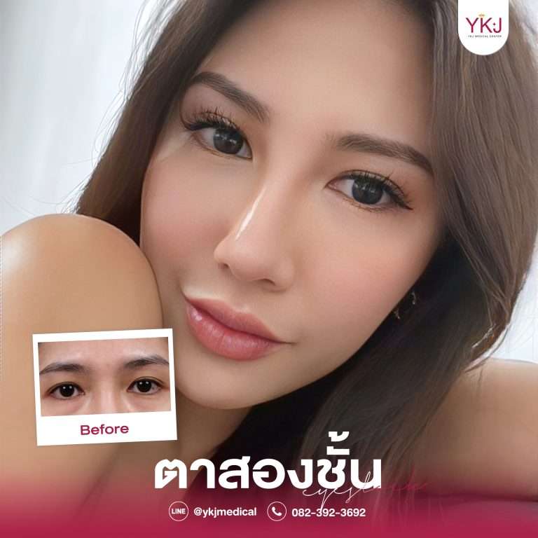 รีวิวตาสองชั้น , รีวิวแก้ตาสองชั้น, ทำตาสองชั้น