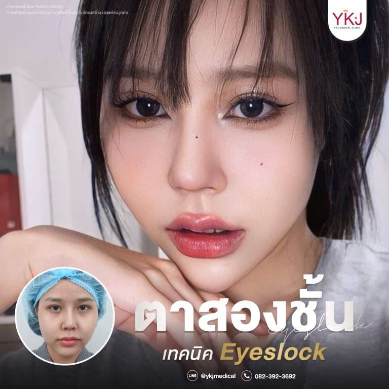 รีวิวตาสองชั้น , รีวิวแก้ตาสองชั้น, ทำตาสองชั้น