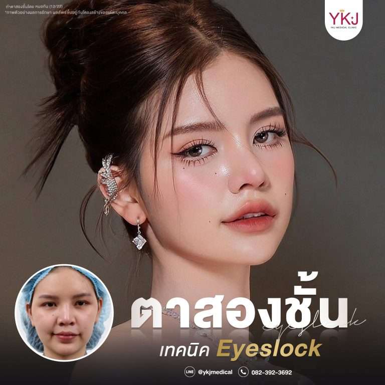 รีวิวตาสองชั้น , รีวิวแก้ตาสองชั้น, ทำตาสองชั้น