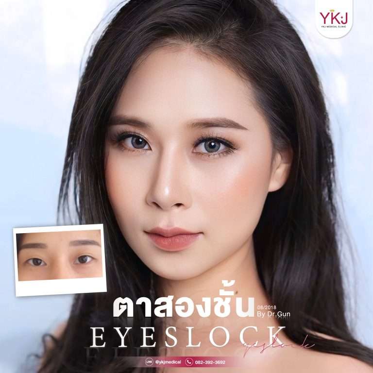 รีวิวตาสองชั้น , รีวิวแก้ตาสองชั้น, ทำตาสองชั้น