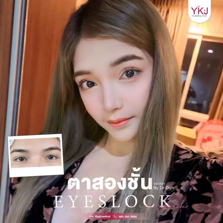 รีวิวตาสองชั้น , รีวิวแก้ตาสองชั้น, ทำตาสองชั้น