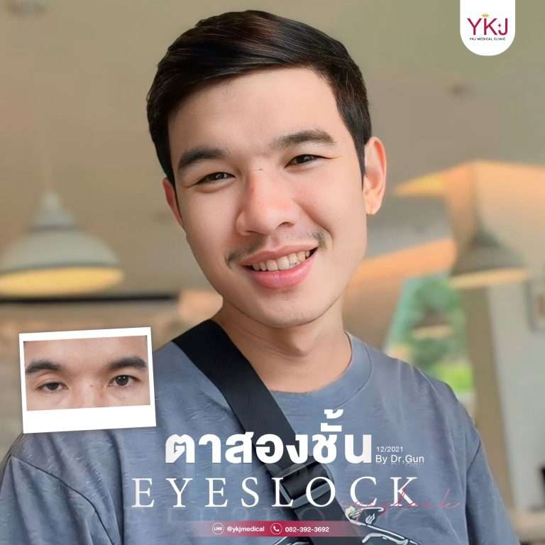 รีวิวตาสองชั้น , รีวิวแก้ตาสองชั้น, ทำตาสองชั้น