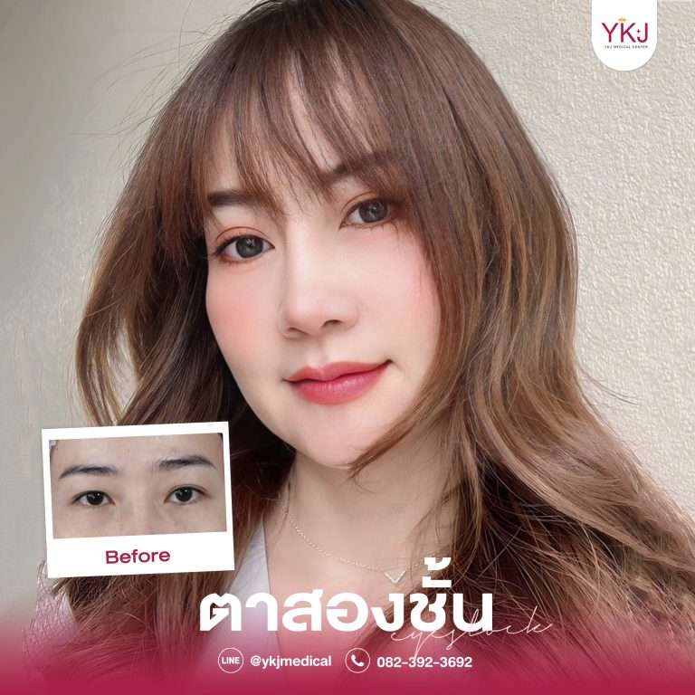 รีวิวตาสองชั้น , รีวิวแก้ตาสองชั้น, ทำตาสองชั้น