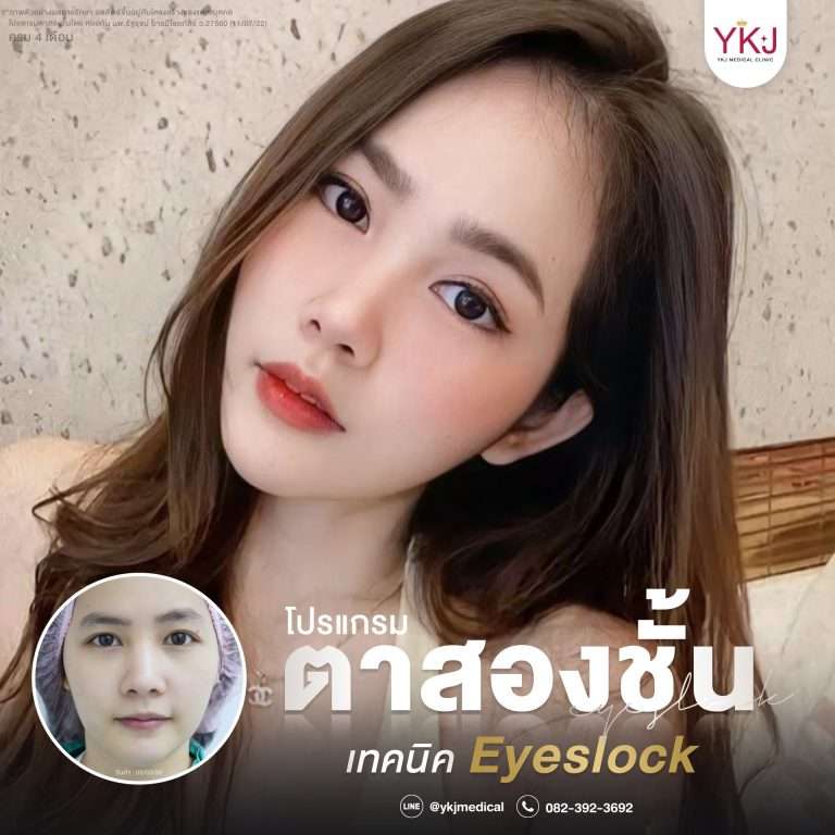 รีวิวตาสองชั้น , รีวิวแก้ตาสองชั้น, ทำตาสองชั้น