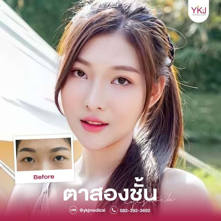 รีวิวตาสองชั้น , รีวิวแก้ตาสองชั้น, ทำตาสองชั้น