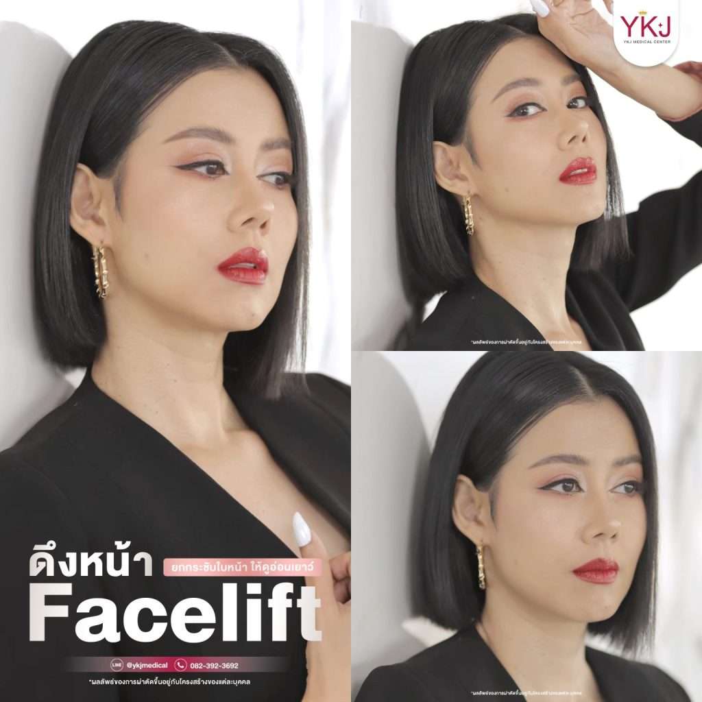 การดึงหน้า-ดึงหน้า