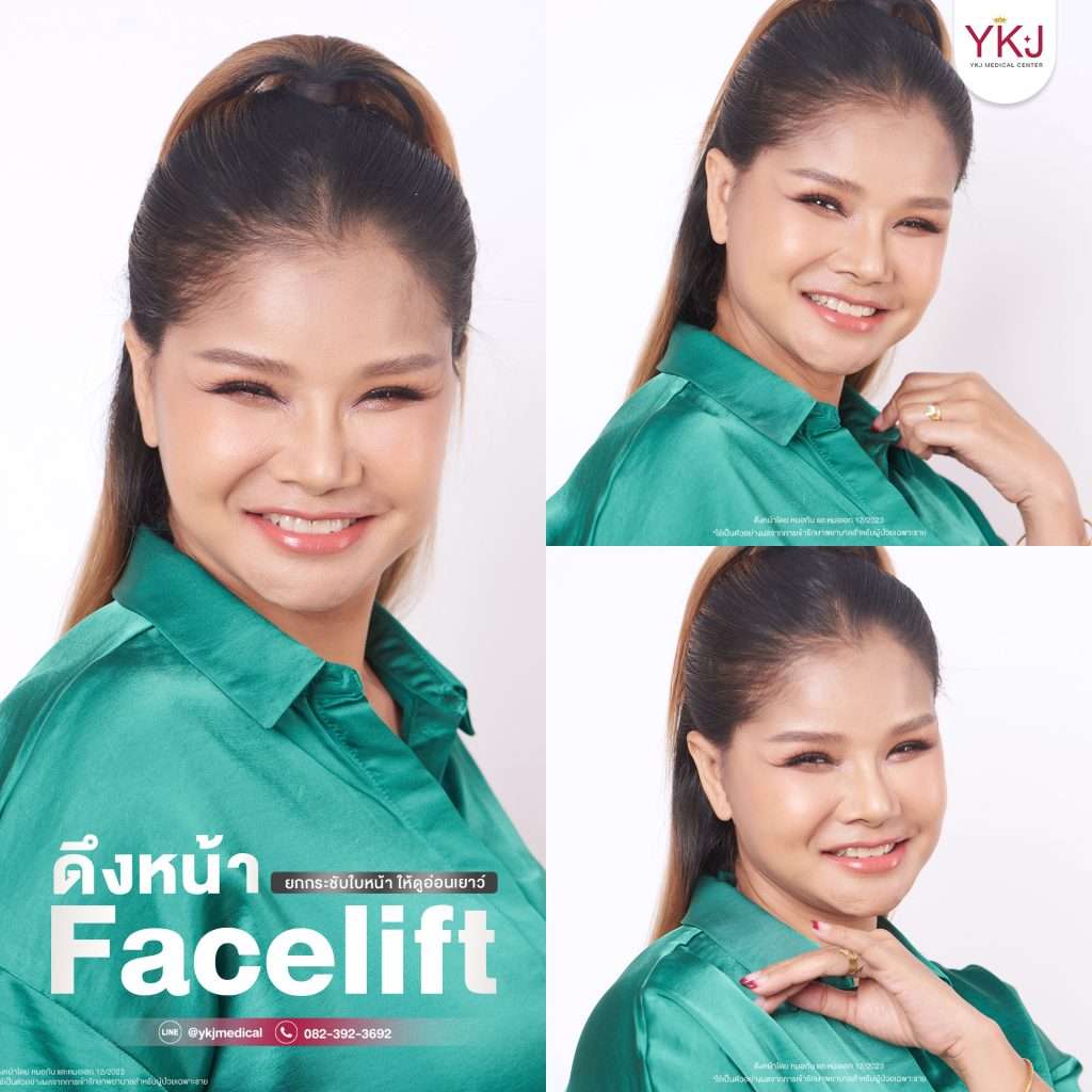 การดึงหน้า-ดึงหน้า-facelift