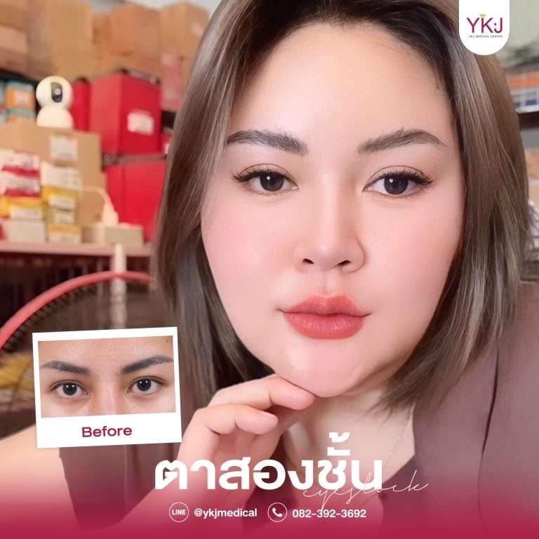 รีวิวตาสองชั้น , รีวิวแก้ตาสองชั้น, ทำตาสองชั้น