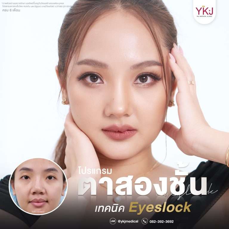 รีวิวตาสองชั้น , รีวิวแก้ตาสองชั้น, ทำตาสองชั้น