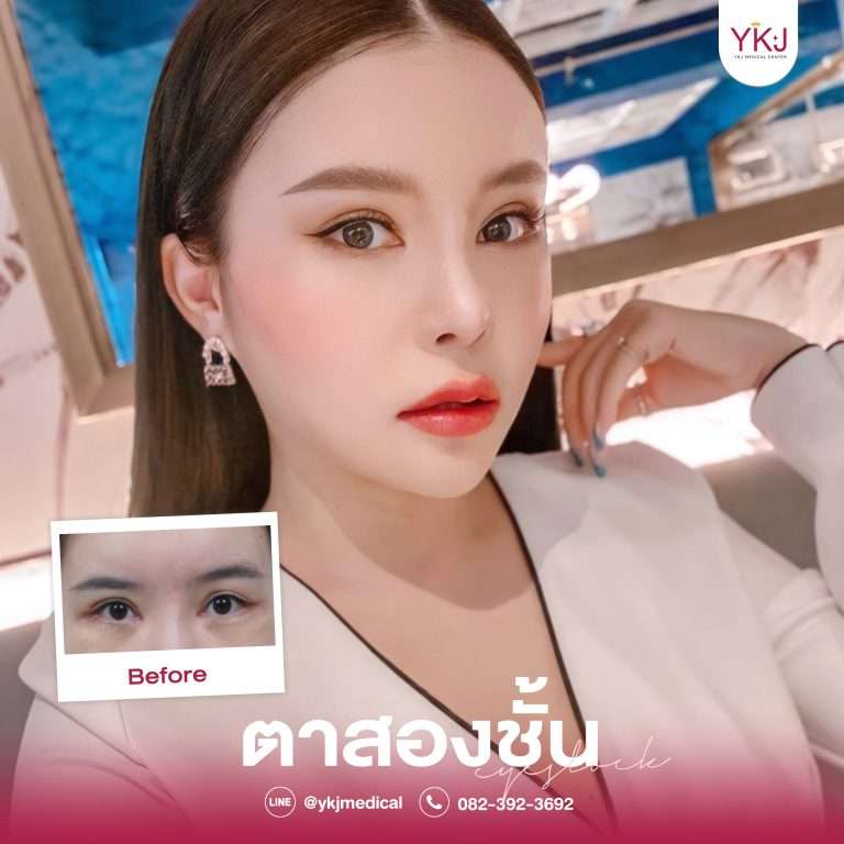 รีวิวตาสองชั้น , รีวิวแก้ตาสองชั้น, ทำตาสองชั้น