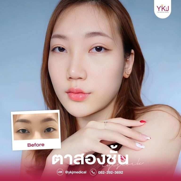 รีวิวตาสองชั้น , รีวิวแก้ตาสองชั้น, ทำตาสองชั้น