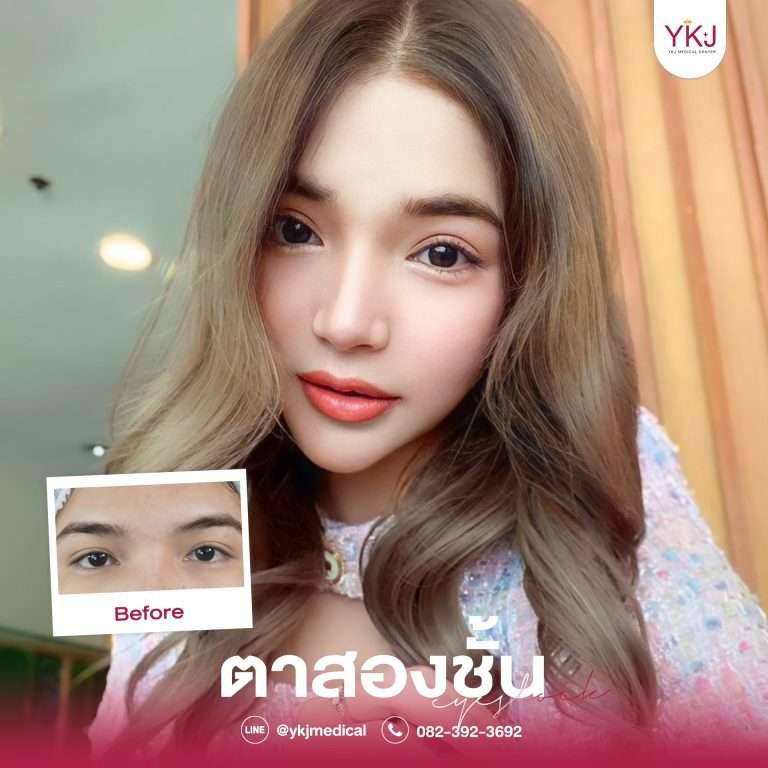 รีวิวตาสองชั้น , รีวิวแก้ตาสองชั้น, ทำตาสองชั้น